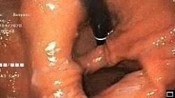 Сочетание аксиальной грыжи больших размеров и параэзофагеальной грыжи больших размеров